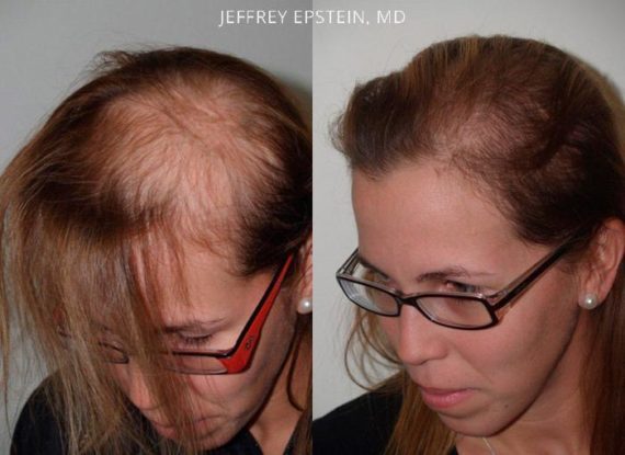 Casos Especiales Before and after in Miami, FL, Paciente 99461