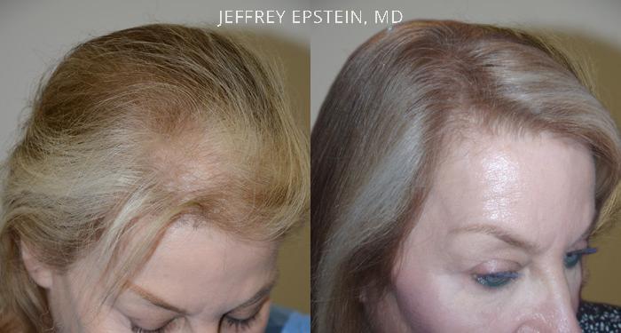 Hair Transplants for Women Before and after in Miami, FL, Paciente 42084