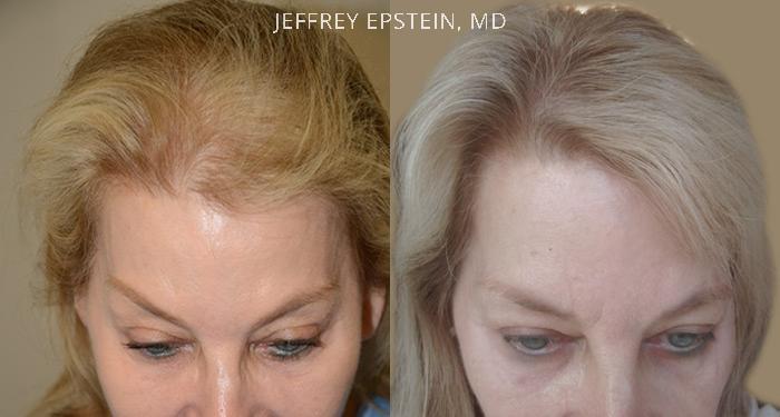 Hair Transplants for Women Before and after in Miami, FL, Paciente 42084