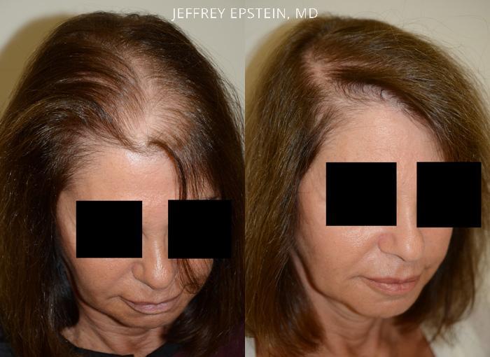 Hair Transplants for Women Before and after in Miami, FL, Paciente 42091
