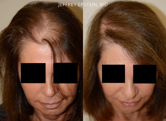 Hair Transplants for Women Before and after in Miami, FL, Paciente 42091