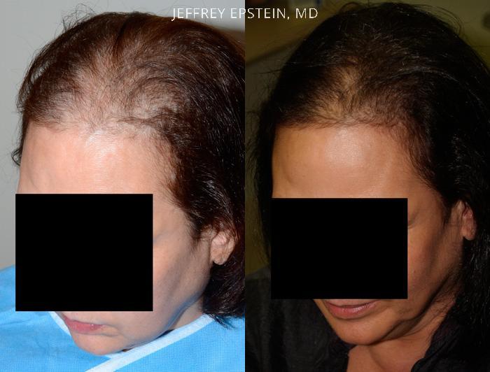 Hair Transplants for Women Before and after in Miami, FL, Paciente 42098