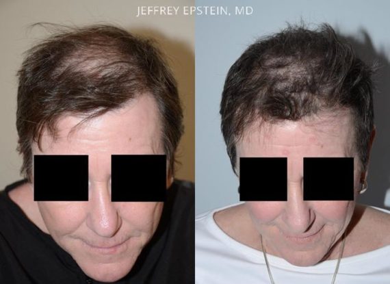 Hair Transplants for Women Before and after in Miami, FL, Paciente 42107