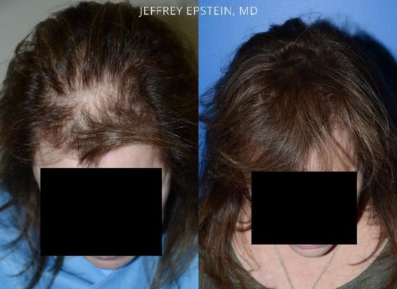 Hair Transplants for Women Before and after in Miami, FL, Paciente 42114