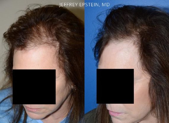 Hair Transplants for Women Before and after in Miami, FL, Paciente 42114