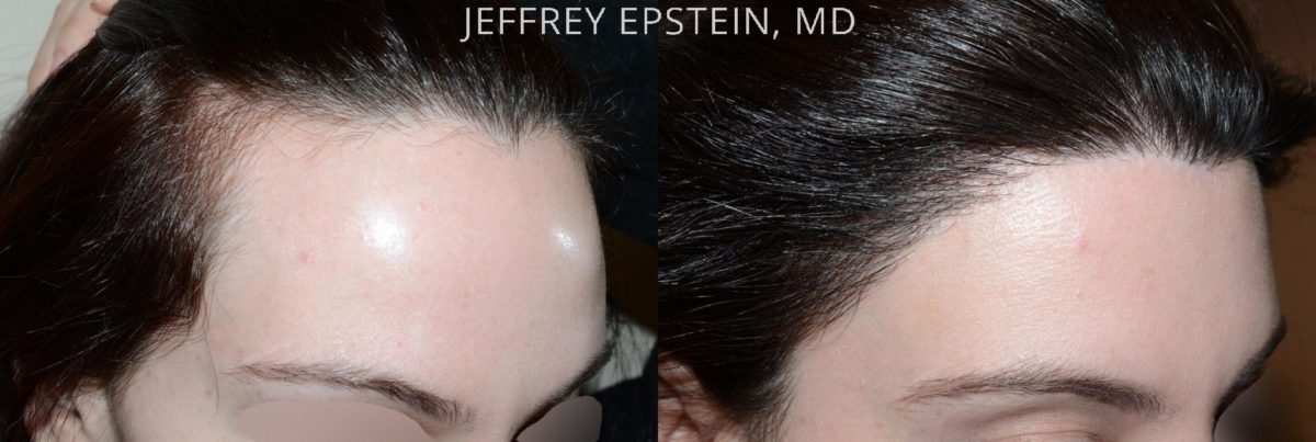 Hair Transplants for Women Before and after in Miami, FL, Paciente 42126