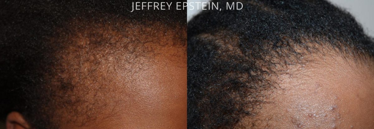 Hair Transplants for Women Before and after in Miami, FL, Paciente 42133
