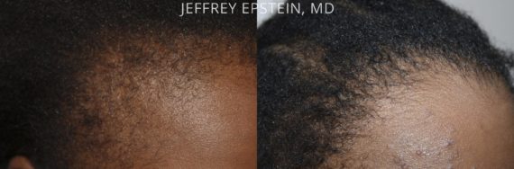 Hair Transplants for Women Before and after in Miami, FL, Paciente 42138
