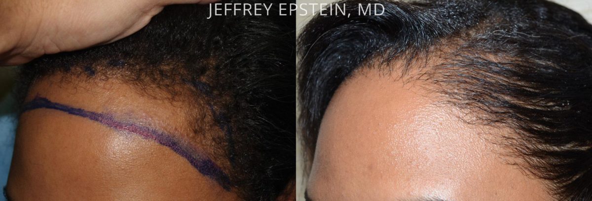 Hair Transplants for Women Before and after in Miami, FL, Paciente 42143