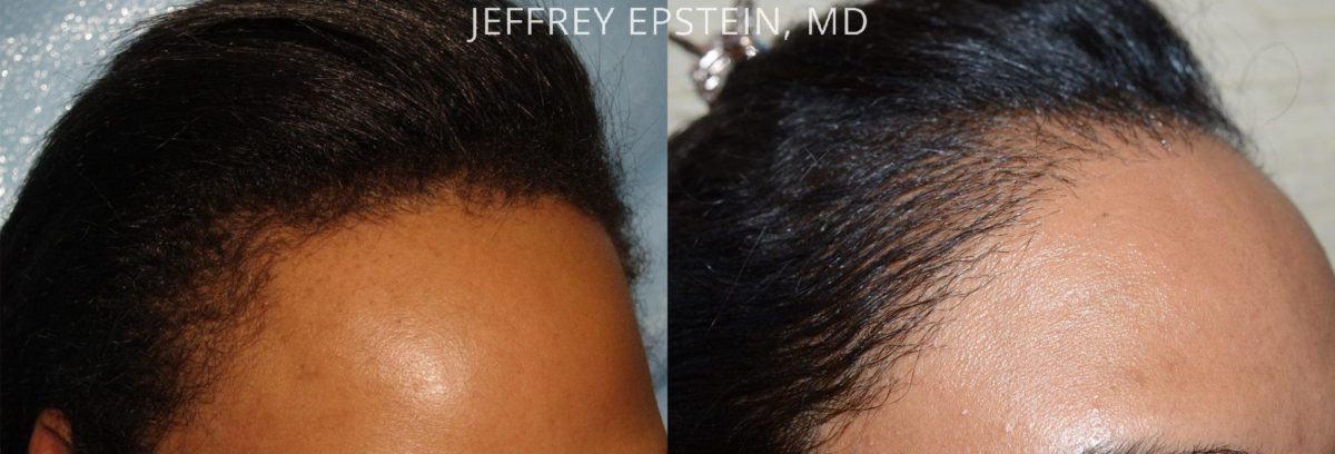 Hair Transplants for Women Before and after in Miami, FL, Paciente 42143