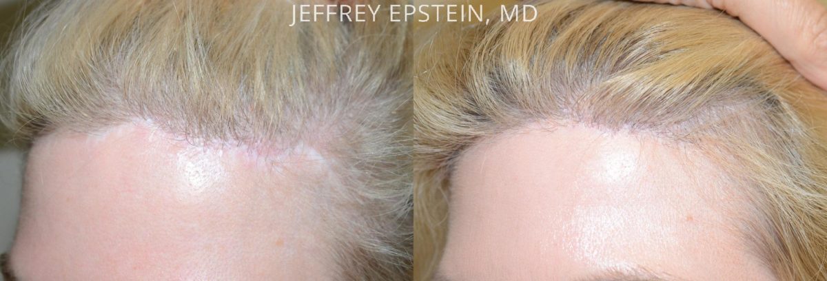 Hair Transplants for Women Before and after in Miami, FL, Paciente 42148