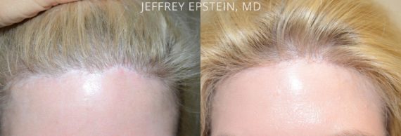 Hair Transplants for Women Before and after in Miami, FL, Paciente 42148