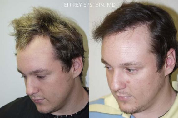 Young Hair Transplant Patients Before and after in Miami, FL, Paciente 42155