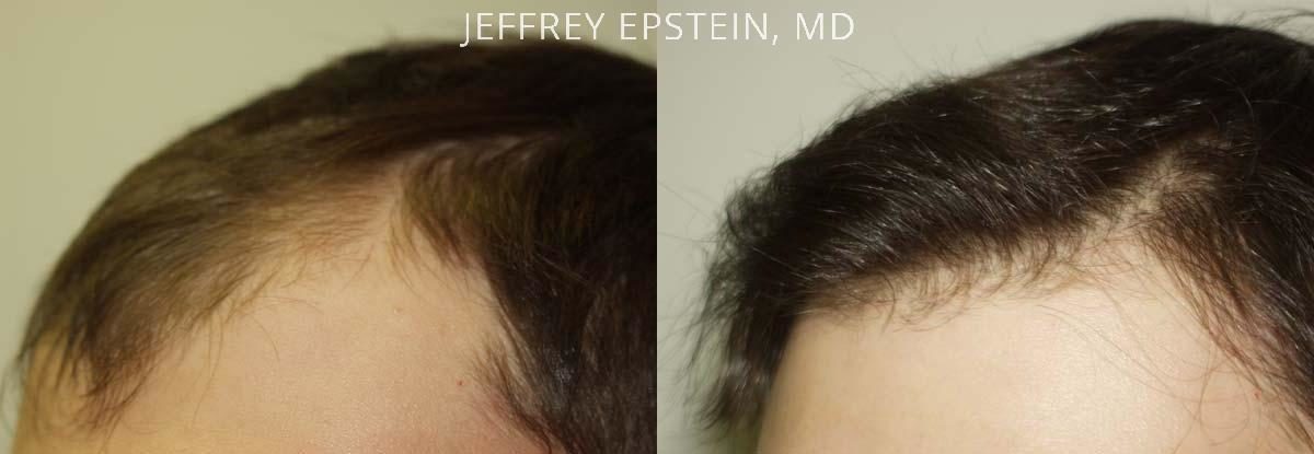 Young Hair Transplant Patients Before and after in Miami, FL, Paciente 42160