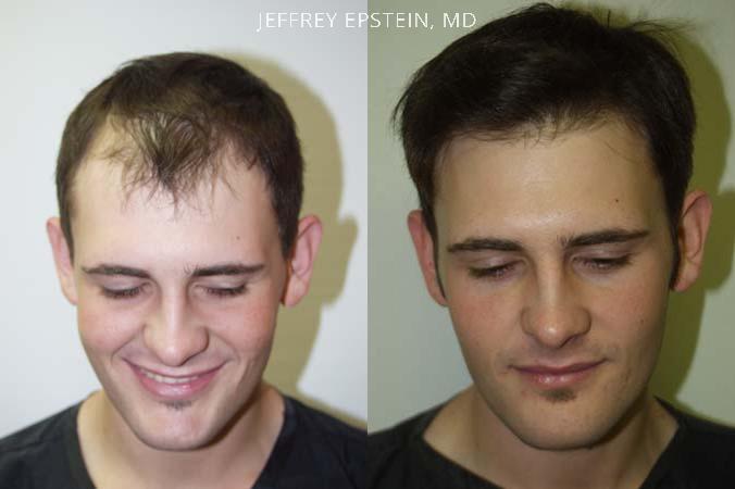 Young Hair Transplant Patients Before and after in Miami, FL, Paciente 42160