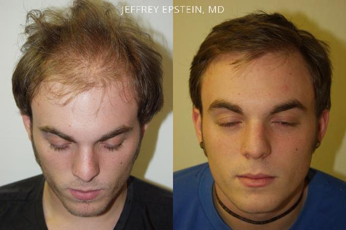 Young Hair Transplant Patients Before and after in Miami, FL, Paciente 42167