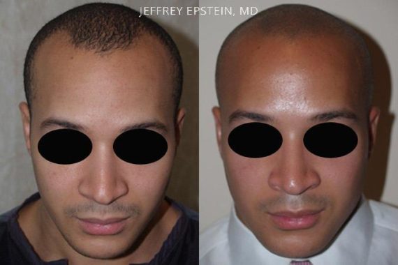 Pacientes con Trasplante Capilar Joven Before and after in Miami, FL, Paciente 95499