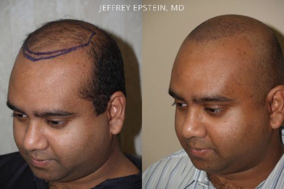 Pacientes con Trasplante Capilar Joven Before and after in Miami, FL, Paciente 95402