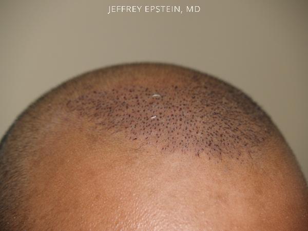 Young Hair Transplant Patients Before and after in Miami, FL, Paciente 42181