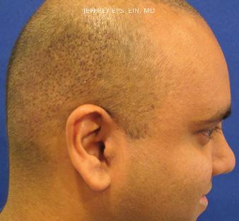 Young Hair Transplant Patients Before and after in Miami, FL, Paciente 42181
