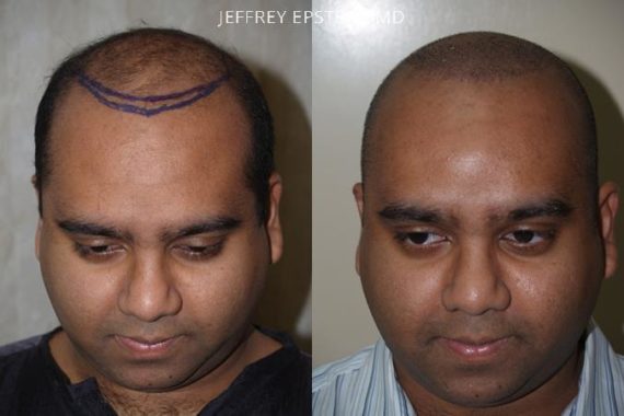 Pacientes con Trasplante Capilar Joven Before and after in Miami, FL, Paciente 95402