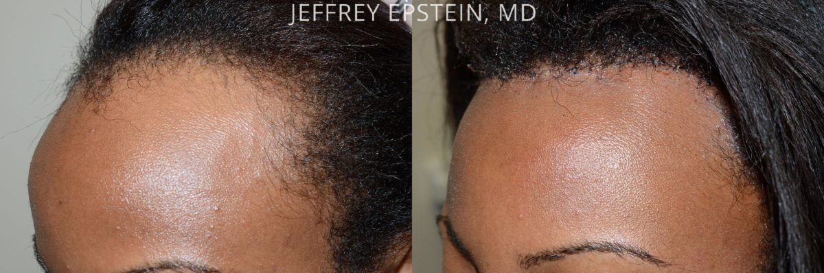 Forehead Reduction Surgery Before and after in Miami, FL, Paciente 47517