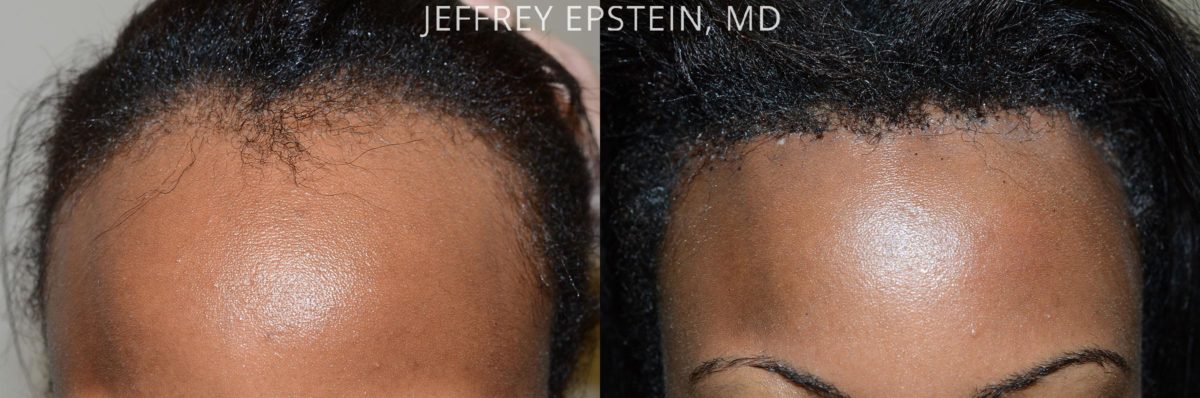 Hairline Advancement Before and after in Miami, FL, Paciente 47517