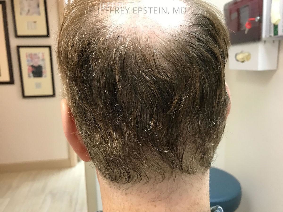 Hair Transplants for Men Before and after in Miami, FL, Paciente 47549