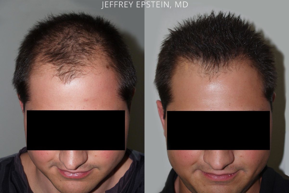 Hair Transplants for Men Before and after in Miami, FL, Paciente 47570