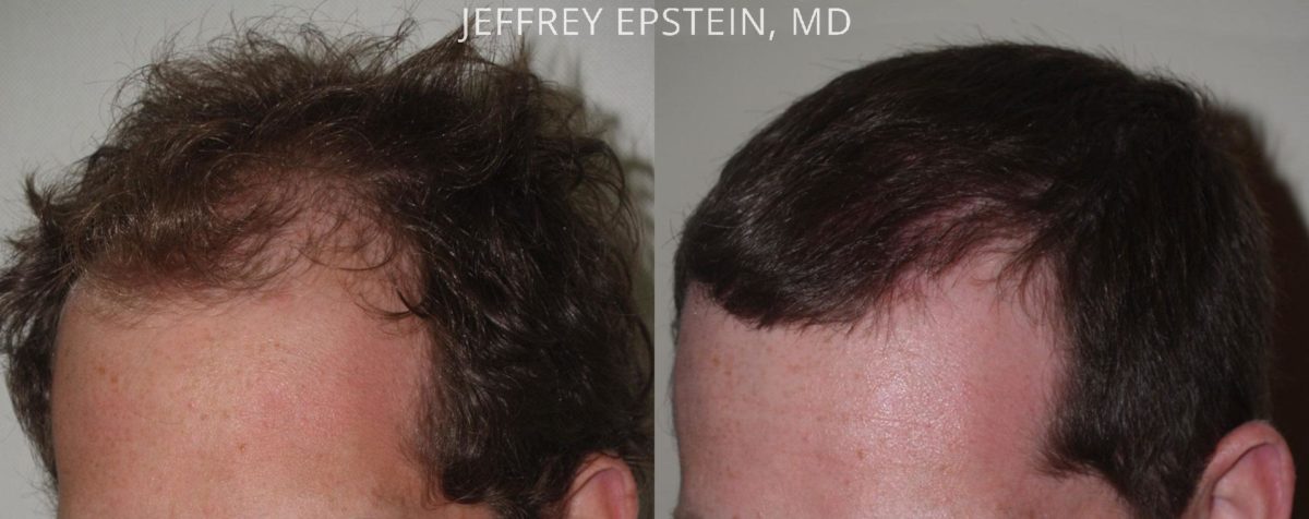 Hair Transplants for Men Before and after in Miami, FL, Paciente 47581