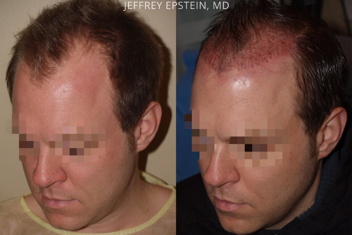 Hair Transplants for Men Before and after in Miami, FL, Paciente 53920