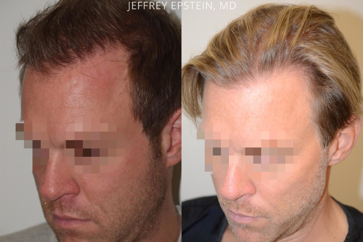 Hair Transplants for Men Before and after in Miami, FL, Paciente 53920