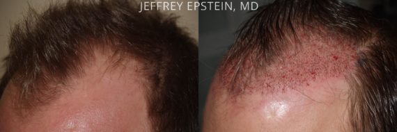 Trasplante de Pelo en Hombres Before and after in Miami, FL, Paciente 74643