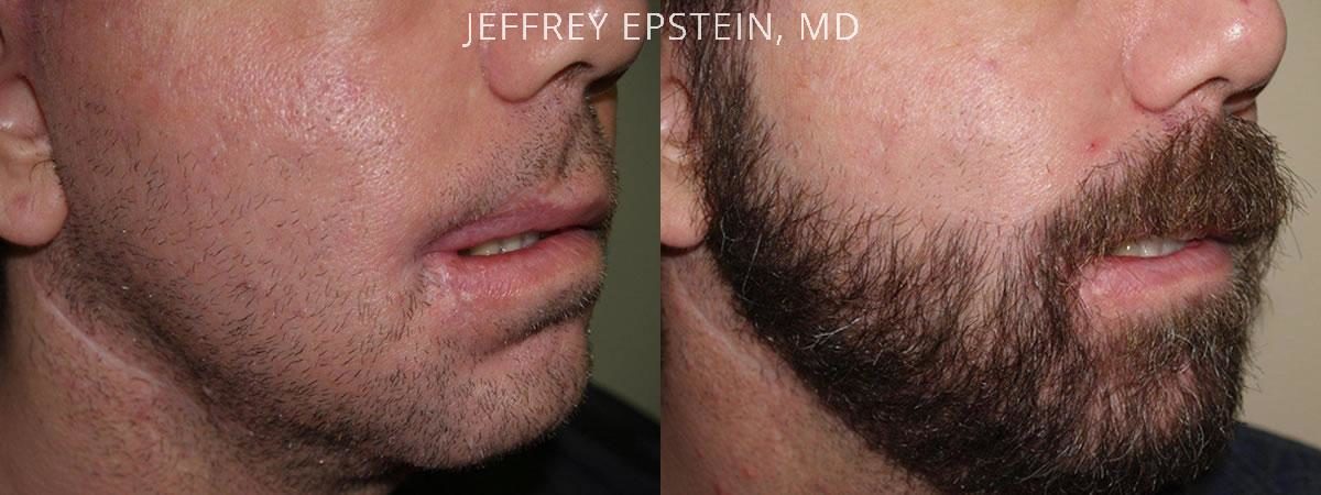 Facial Hair Transplant Before and after in Miami, FL, Paciente 54009