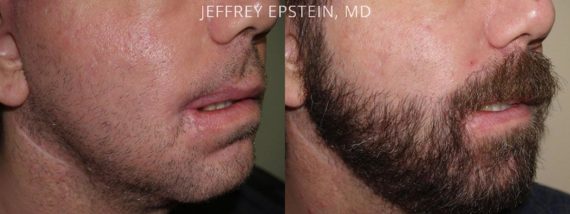 Facial Hair Before and after in Miami, FL, Paciente 54009