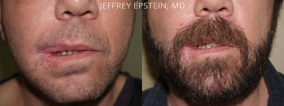 Trasplante de Pelo Facial Antes y después en Miami, FL, Paciente 71136