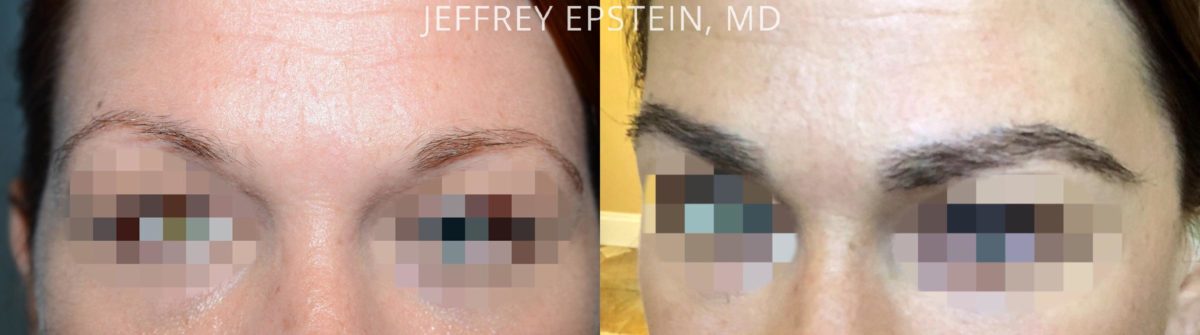 Eyebrow Hair Transplant Before and after in Miami, FL, Paciente 54031