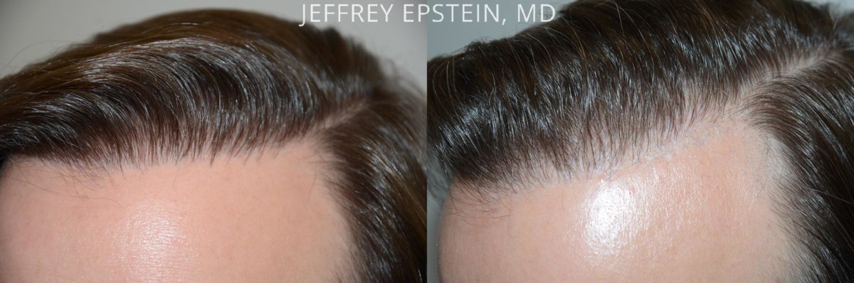 Reparative Hair Transplant Before and after in Miami, FL, Paciente 54036