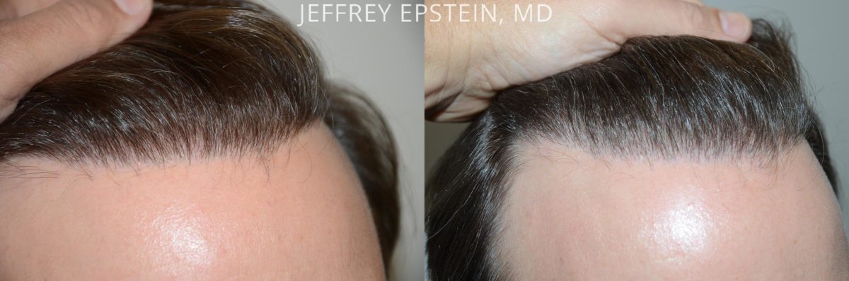 Reparative Hair Transplant Before and after in Miami, FL, Paciente 54036