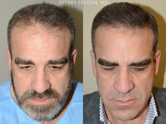 Hair Transplants for Men Before and after in Miami, FL, Paciente 54176