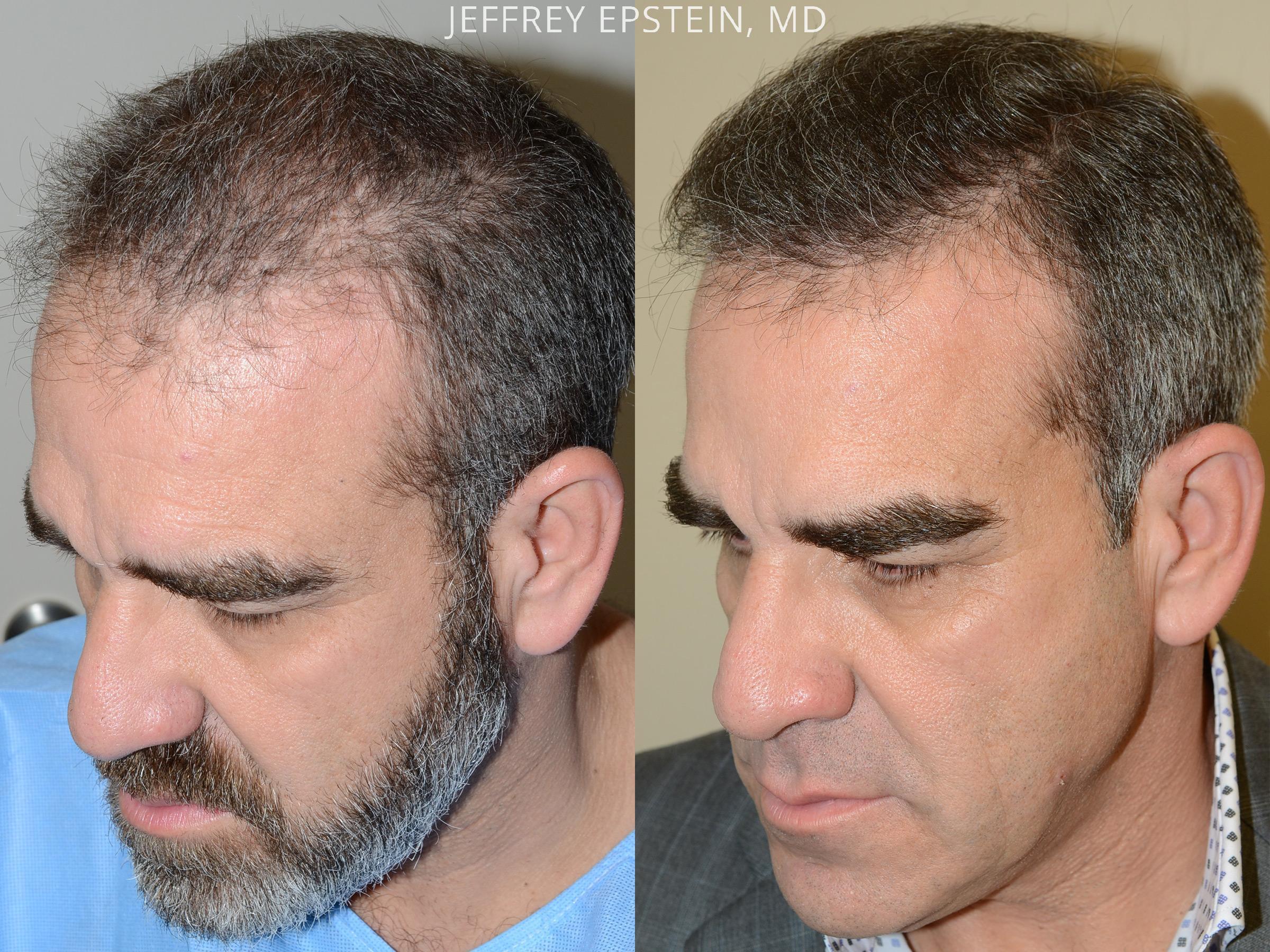 Hair Transplants for Men photos | Miami, FL | Patient54176