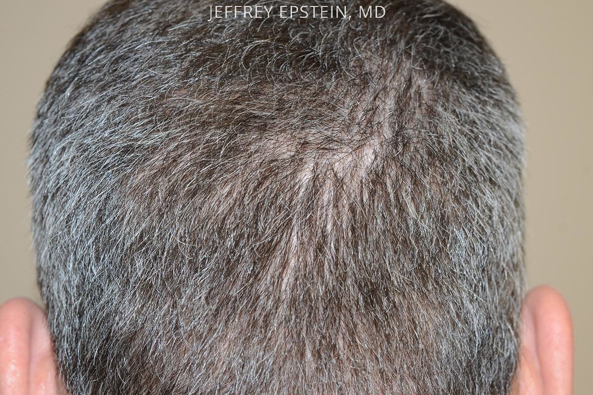 Hair Transplants for Men Before and after in Miami, FL, Paciente 54176