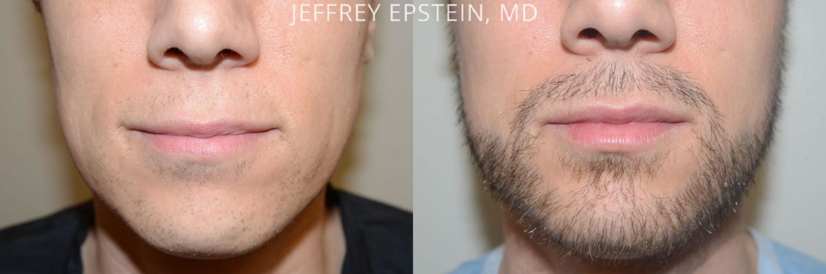 Trasplante de Pelo Facial Antes y después en Miami, FL, Paciente 71117