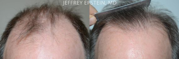 Hair Transplants for Men Before and after in Miami, FL, Paciente 57697