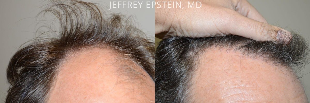 Hair Transplants for Men Before and after in Miami, FL, Paciente 57664