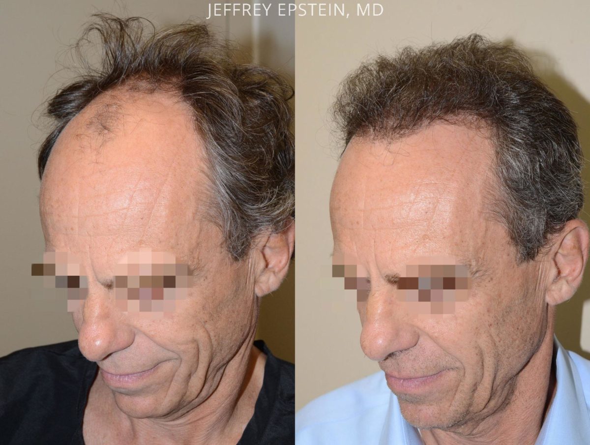 Hair Transplants for Men Before and after in Miami, FL, Paciente 57664