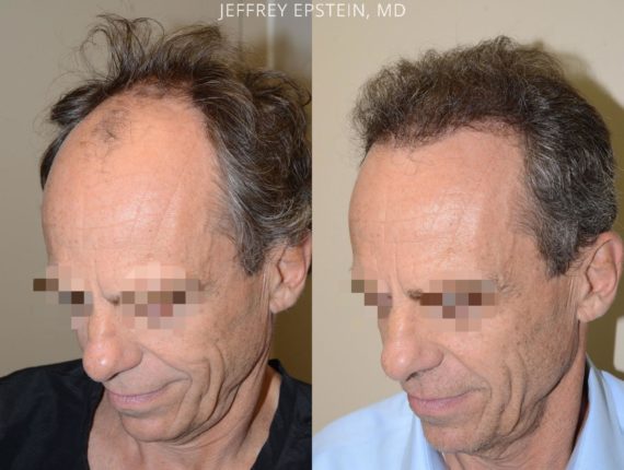 Trasplante de Pelo en Hombres Before and after in Miami, FL, Paciente 74558