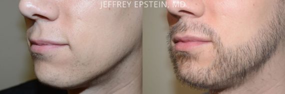 Facial Hair Transplant Before and after in Miami, FL, Paciente 57686