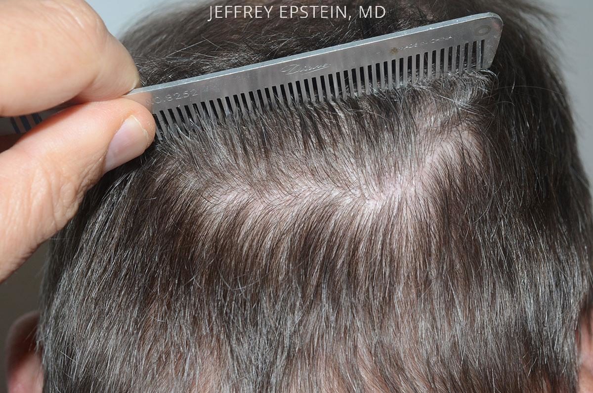 Hair Transplants for Men Before and after in Miami, FL, Paciente 57697