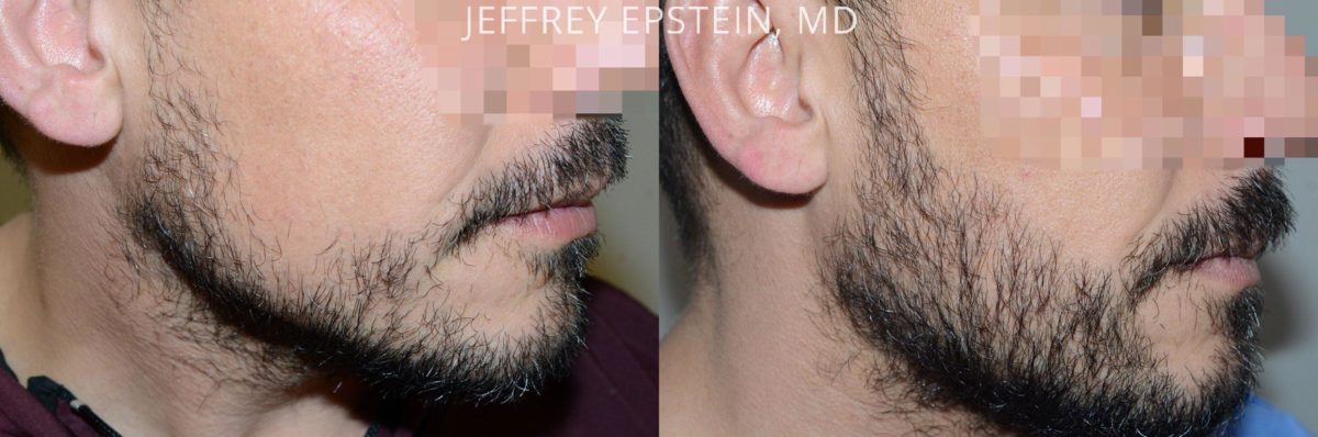 Facial Hair Transplant Before and after in Miami, FL, Paciente 57708